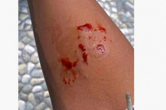 Ինդոնեզիայում կոբրայի խայթոց ստացած դեռահասն օգնություն է խնդրել սոցցանցում և չստանալով այն՝ մահացել