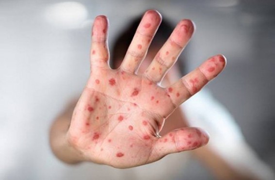 Հայաստանում արձանագրվել է կարմրուկի չորրորդ բերովի դեպքը