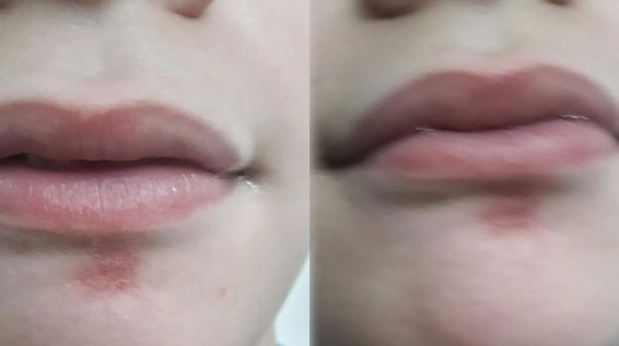 У ребенка слюноотделение, и непрерывное ношение маски в школе повредило ему лицо: запись матери