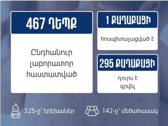 Հայաստանում կարմրուկի հաստատված դեպքերի թիվը հասել է 467-ի