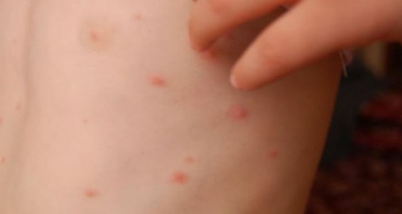 СМИ: в Европе стремительно распространяется опасный «супергрибок»