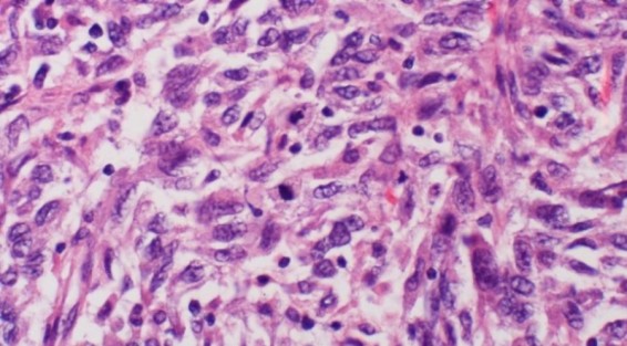 Ամերիկացի գիտնականները մելանոմայի զարգացումը կասեցնող միջոց են հայտնաբերել