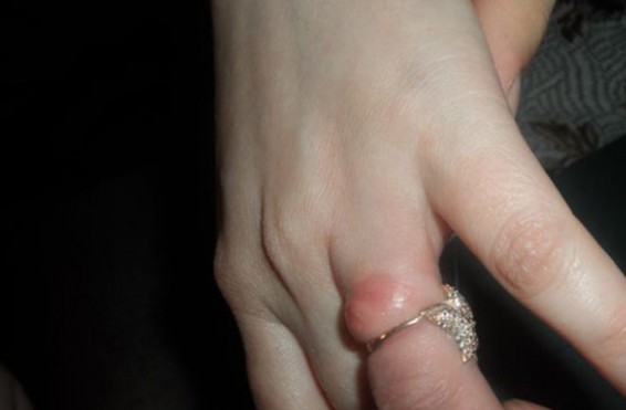 Բնակչի մատանին մնացել է մատին. մեկնել է մեկ մարտական հաշվարկ