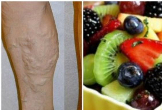 Հատուկ դիետան կօգնի պայքարել երակների վարիկոզ լայնացման դեմ