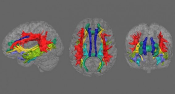 Դեպրեսիան ուղեղի սպիտակ նյութում փոփոխություններ է առաջացնում. հետազոտություն