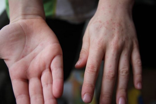 Թուրքիայում հարյուրավոր ռուսաստանցիներ գանգատվել են ինքնազգացողության վատթարացումից